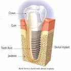 Wangaratta dental implant