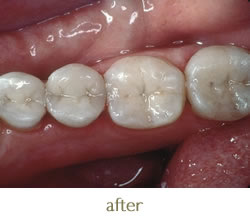 After photo - new tooth coloured fillings