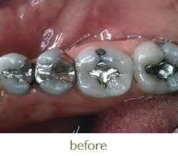 Before photo - old metal fillings