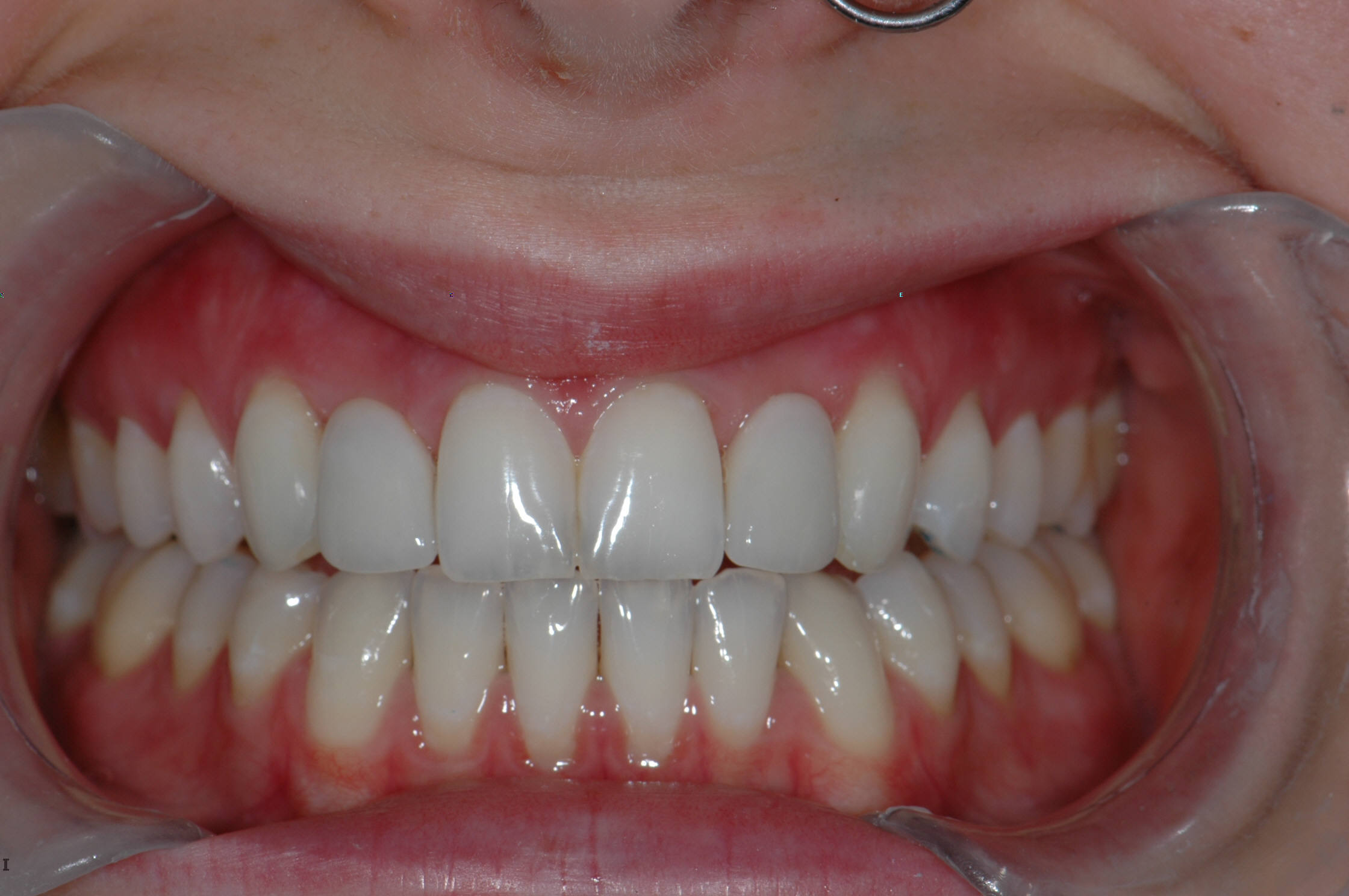 After Porcelain Bridge