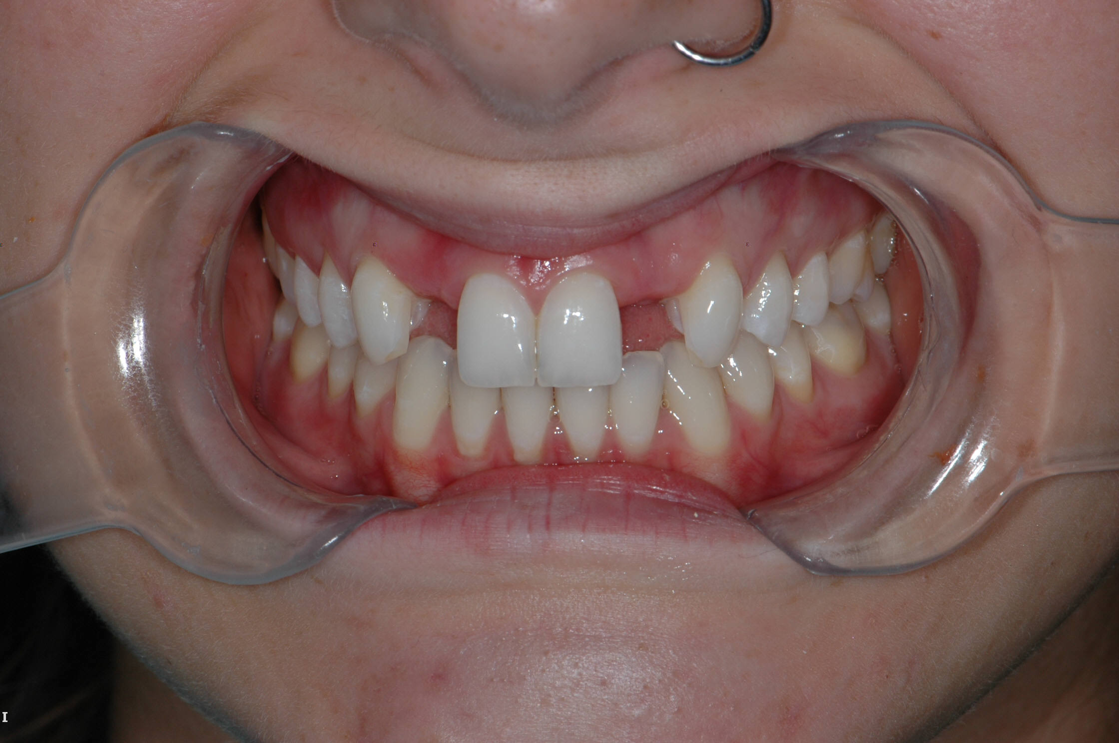 Before Porcelain Bridge