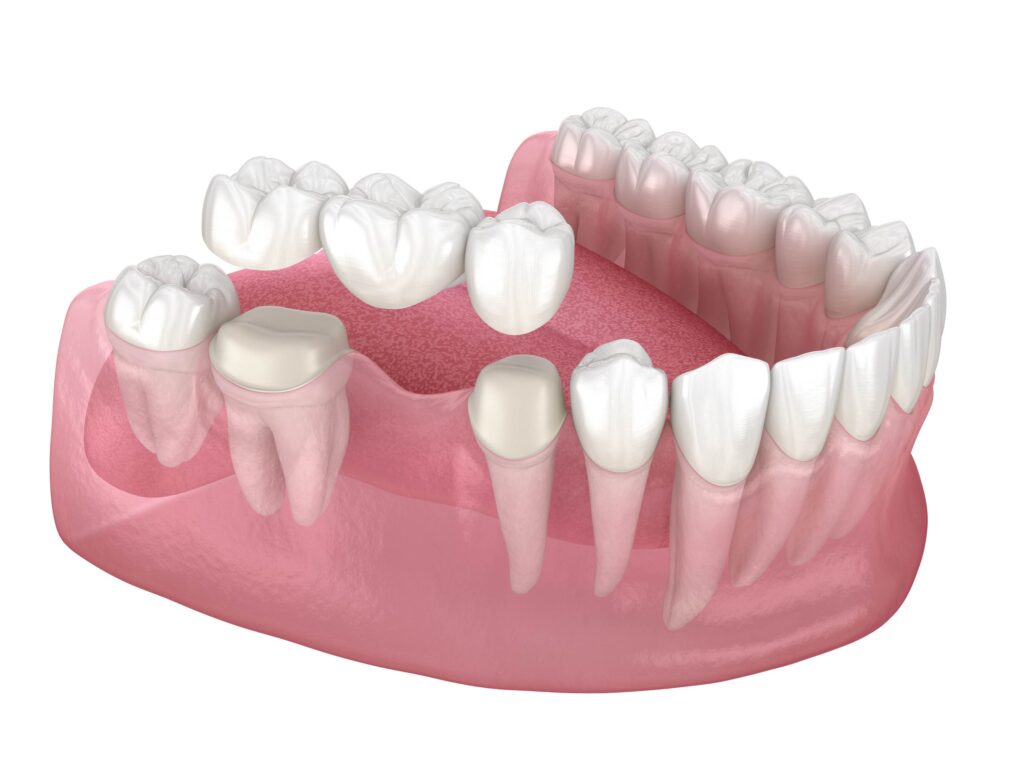 dental bridge of 3 teeth over molar