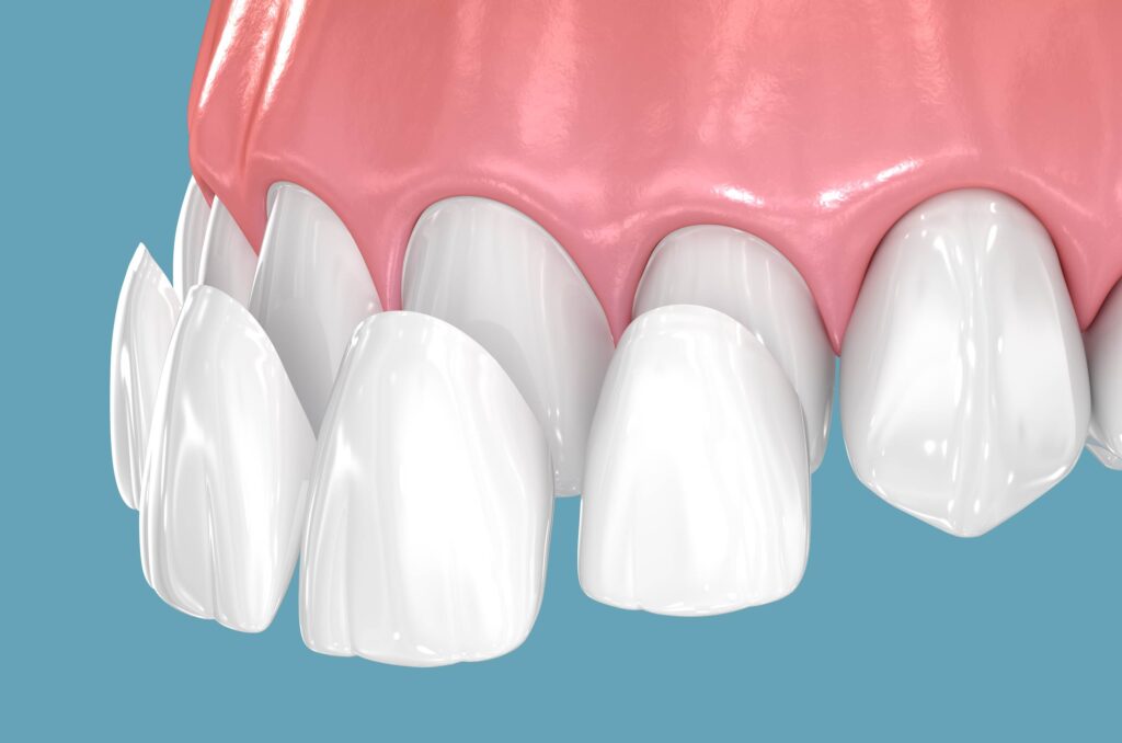 dental veneers 3d illustration
