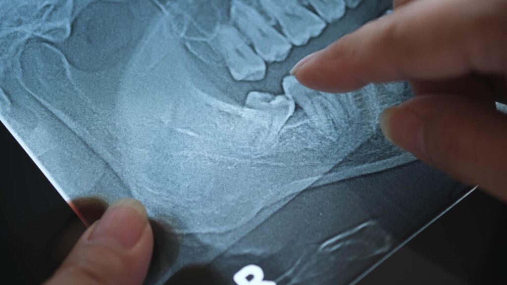 panoramic x ray image of teeth and mouth with wisdom teeth