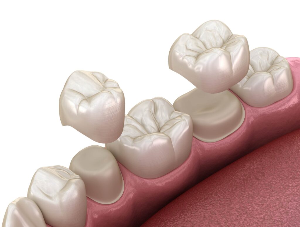 porcelain crowns placement