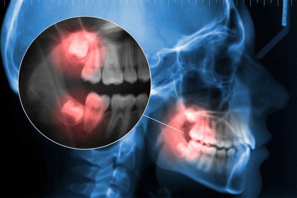 wisdom teeth on xray