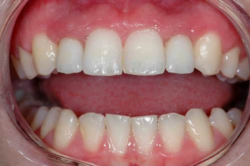 after implant