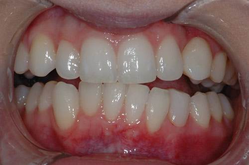 after whitening and veneers