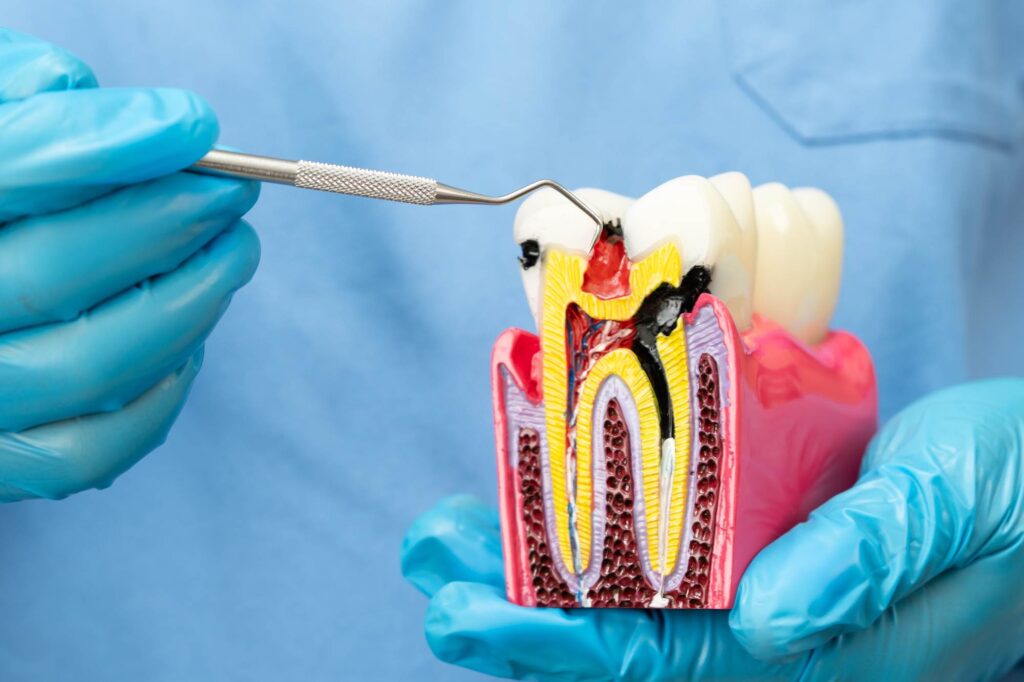 artificial tooth roots into jaw