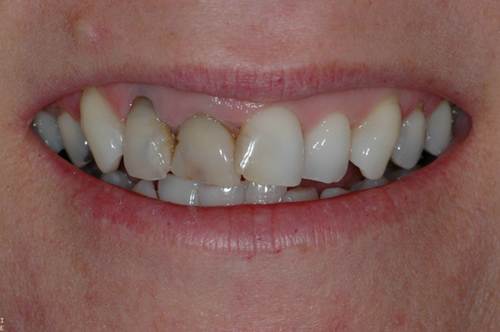 before implant retained bridge