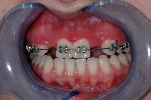 before implant