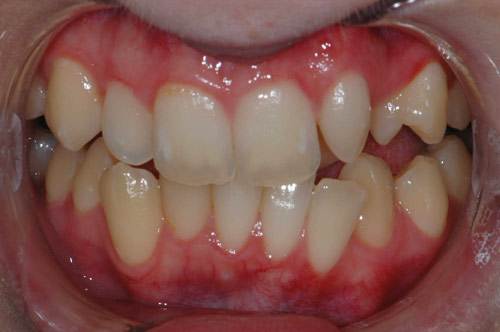 before whitening and veneers