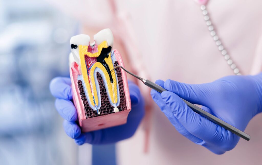 close up of tooth decay model caries