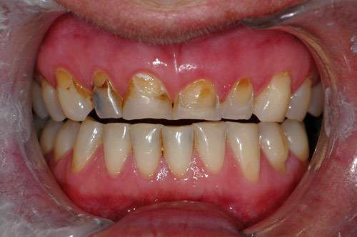 composite veneers1 before