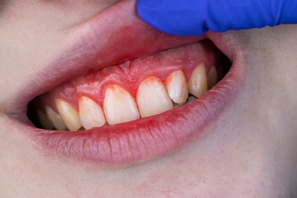 gums and deeper periodontal structures become inflamed