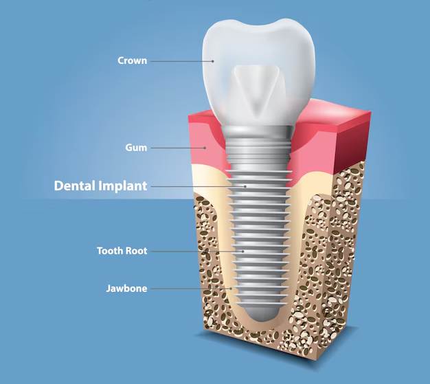 human teeth dental implant vector illustration 73621 420