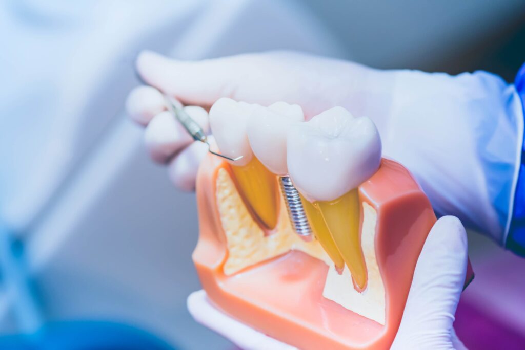 tooth implant false teeth