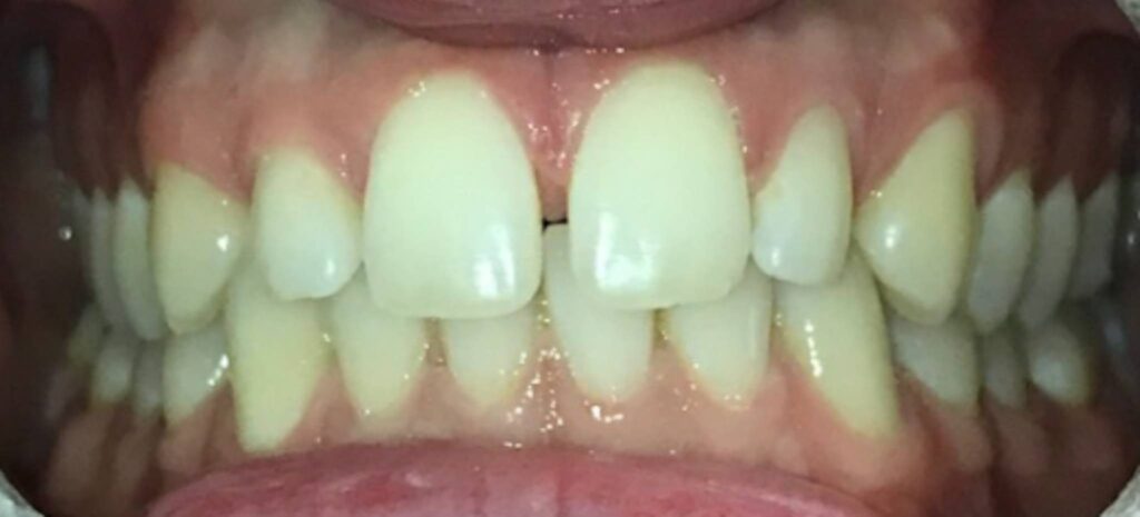 invisalign veneers before