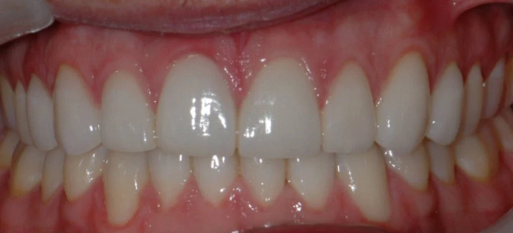 invisalign veneers after