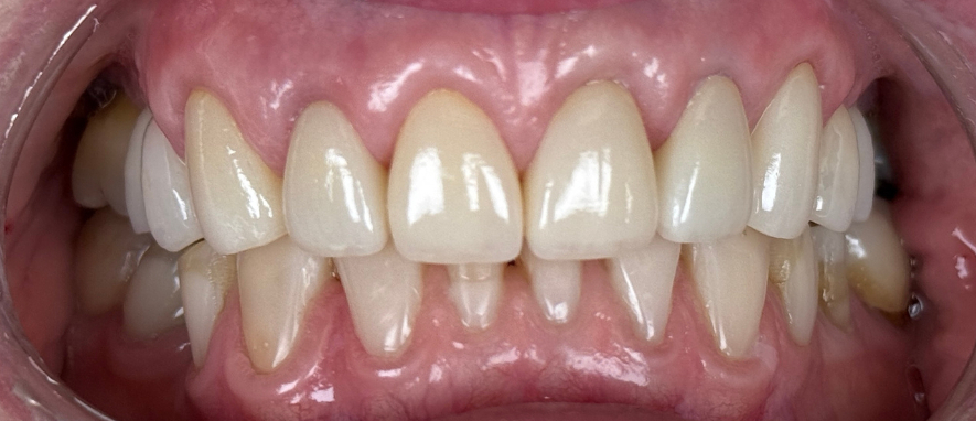 porcelain crown after (1)