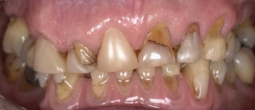 porcelain crown after