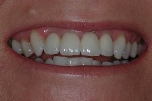 after implant retained bridge (1)