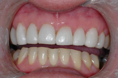 composite veneers1 after (1)